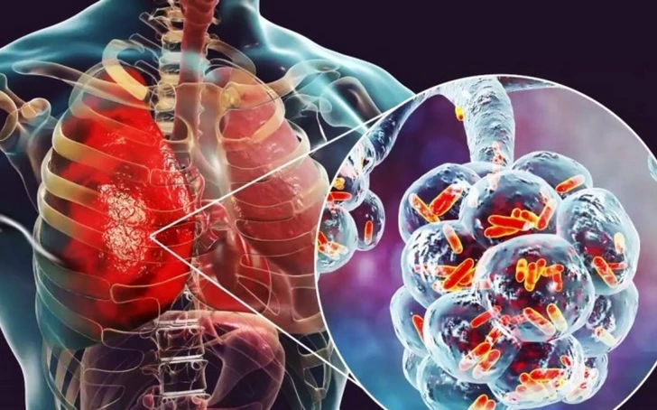 Endişe Verici İstatistik: Azerbaycan’da Zatürre Hastalığı Artıyor